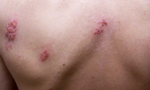 Shingles on men herpes zoster. Closeup.
